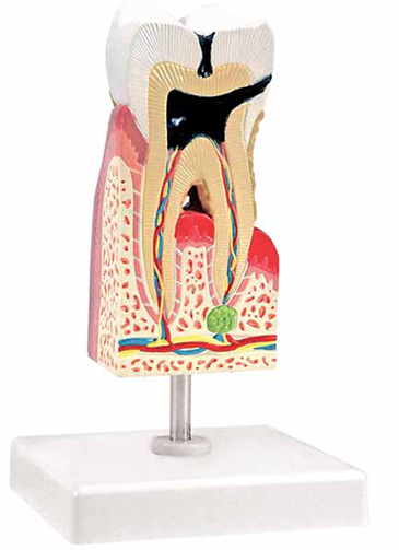 Lower Molar with Caries